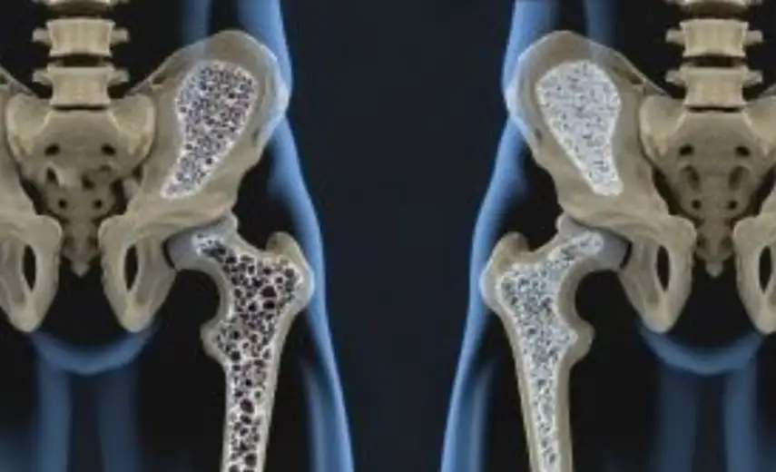 Svetski dan borbe protiv osteoporoze